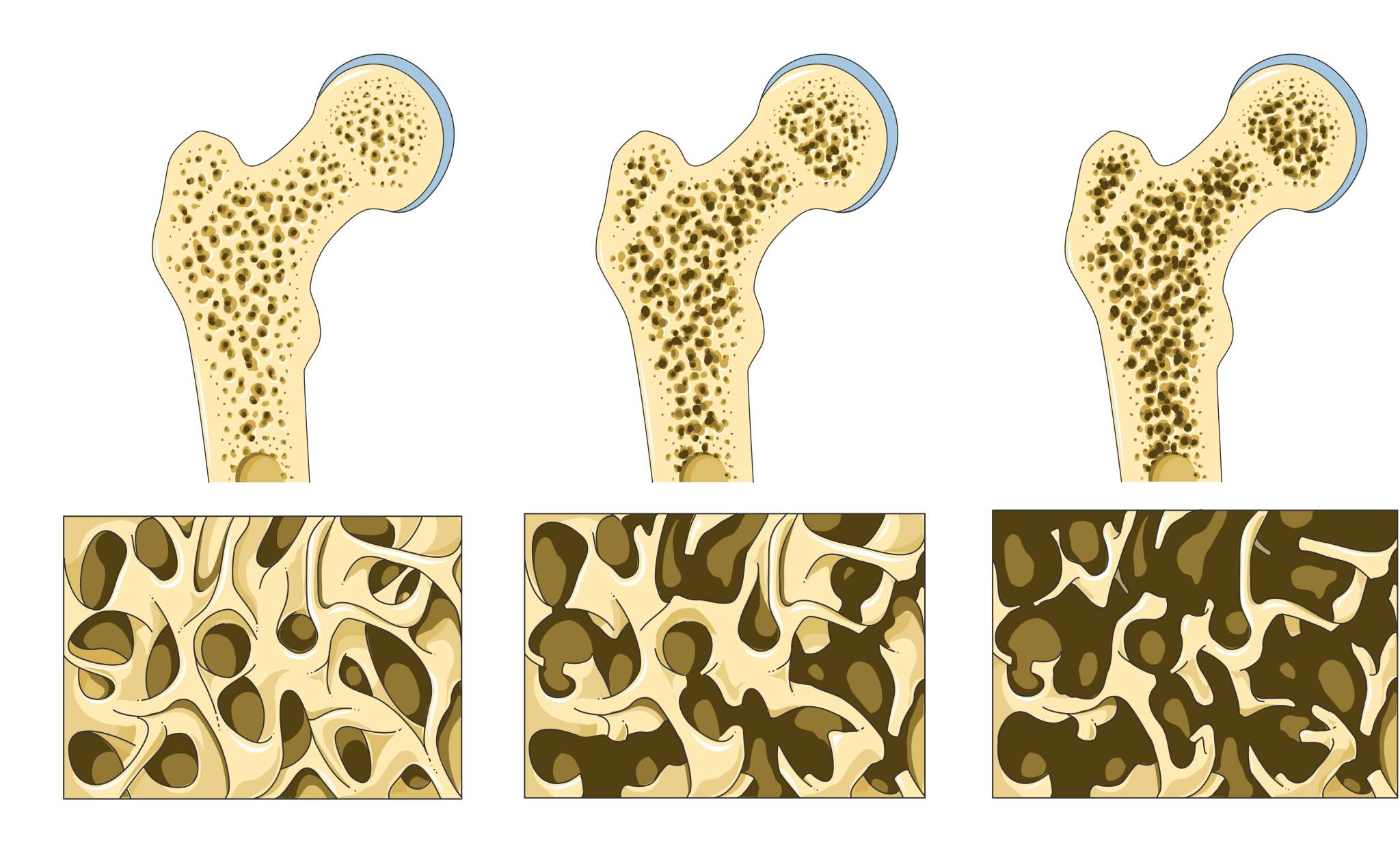 Osteoporosis 02