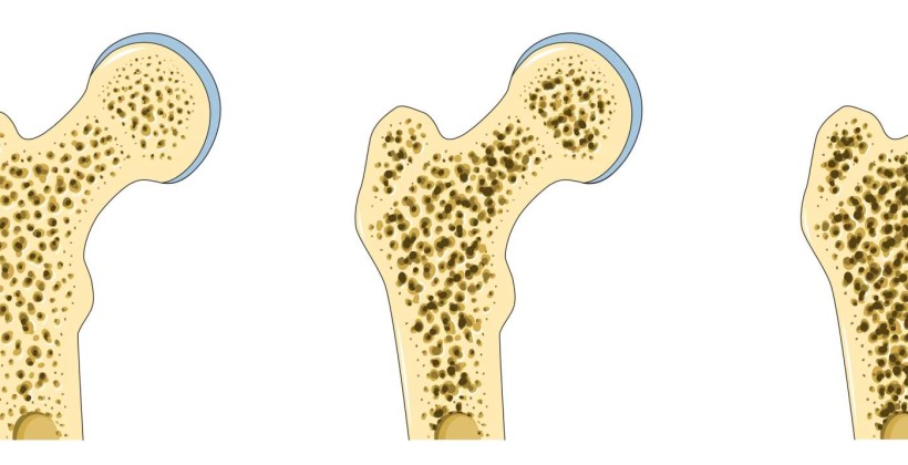 Osteopenia y Osteoporosis